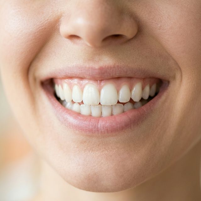 Teeth Whitening